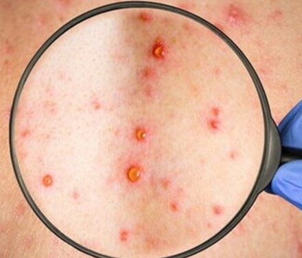 شناسایی ۲۴ مورد مشکوک به سرخک در کهگیلویه و بویراحمد/ لزوم واکسیناسیون به موقع کودکان ۱۲ تا ۱۸ ماه