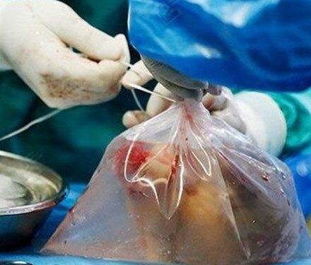 ادامه ایثارگری یک ایثارگر/ اهدا عضو آزاده گچسارانی  به بیماران نیازمند