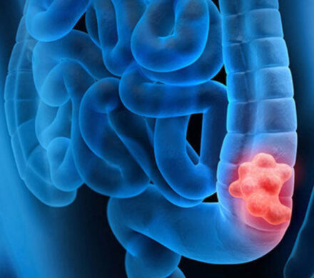 چطور جلوی سرطان روده را بگیریم؟